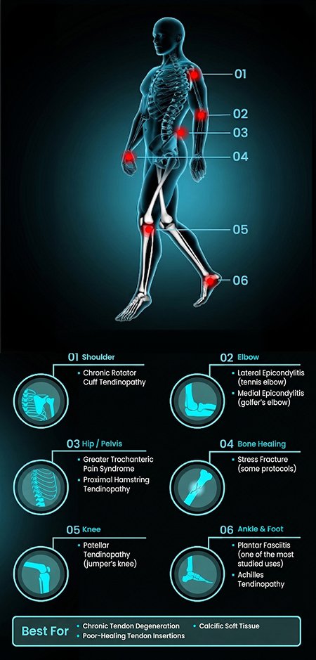 shockwave-therapy-graphic-01sm